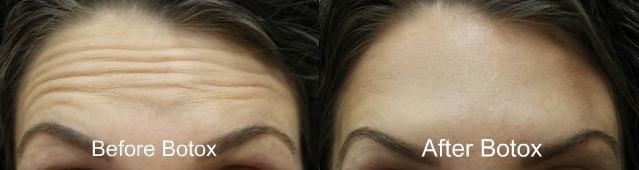 Botox Treatment at Texas Institute of Dermatology 